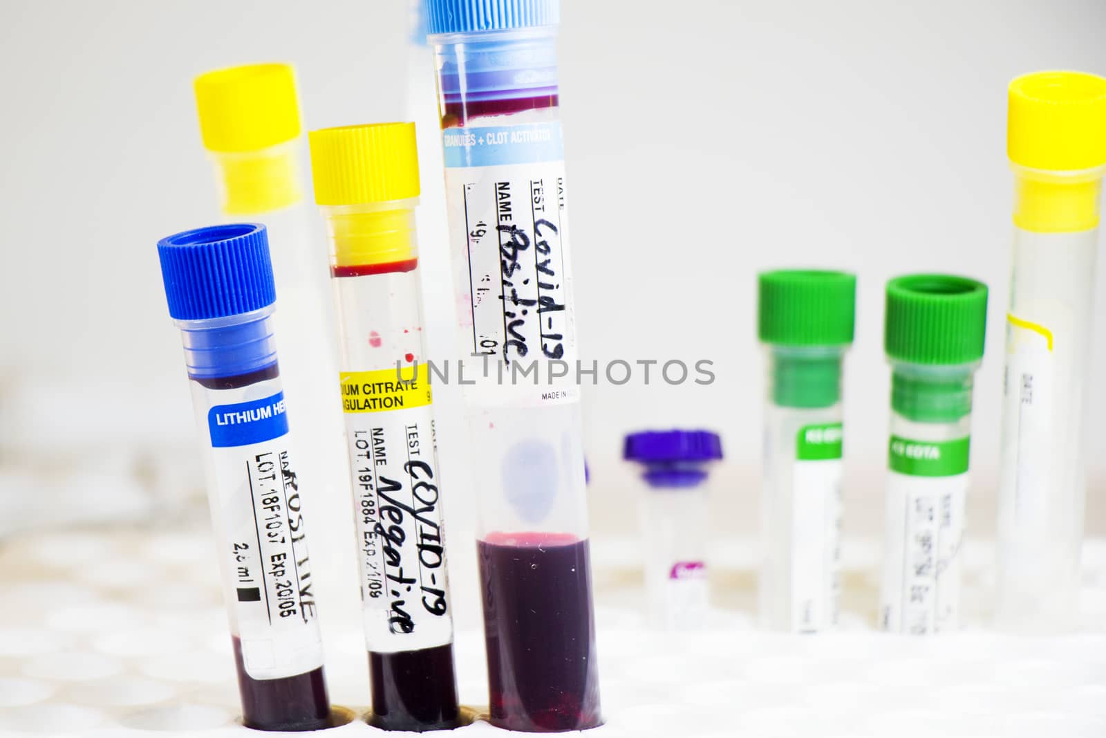 Corona virus, NCOV and Covid - 19 positive test samples. Blood tube samples. Diagnoses and laboratory research. by Taidundua