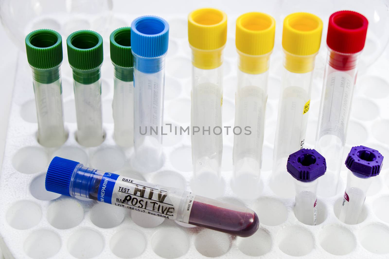 Hiv and aids infection blood test sample, diagnoses and laboratory chemical liquid elements by Taidundua