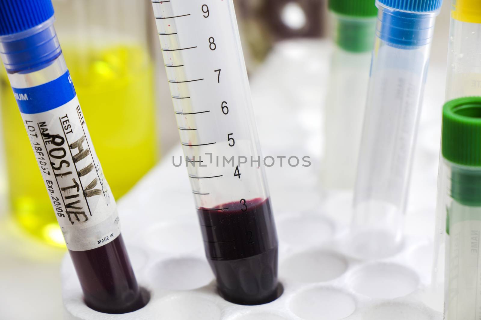 Hiv and aids infection blood test sample, diagnoses and laboratory chemical liquid elements, studio shoot on the white background