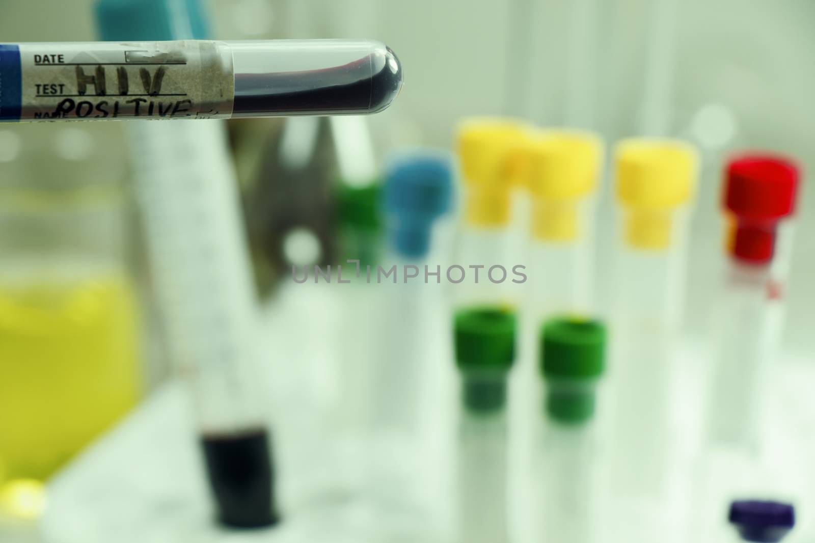 Hiv and aids infection blood test sample, diagnoses and laboratory chemical liquid elements, studio shoot on the white background