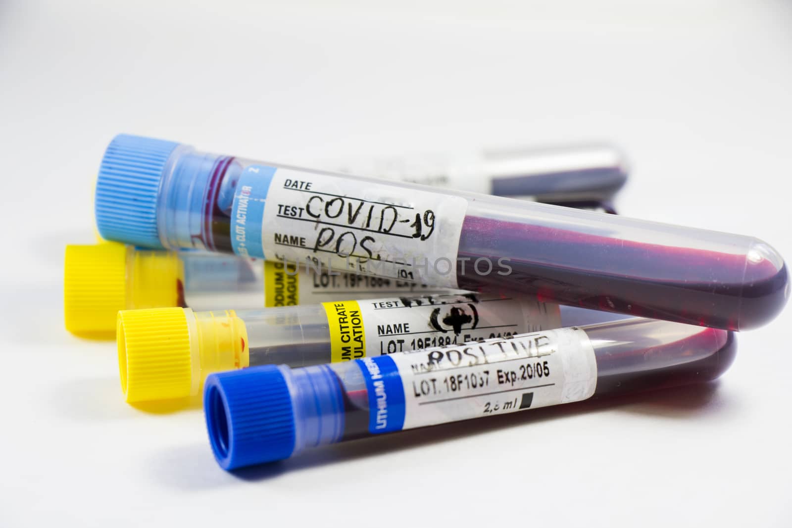 Corona virus, NCOV and Covid - 19 positive test samples. Blood tube samples. Diagnoses and laboratory research. by Taidundua