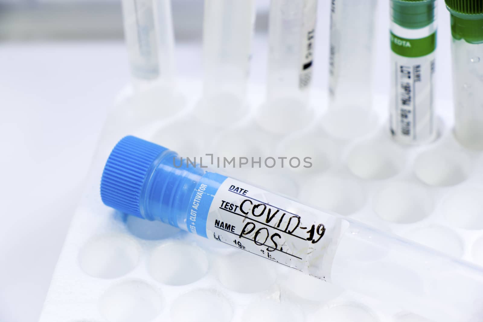 Corona virus and Covid-19 positive test samples. Diagnosis and l by Taidundua
