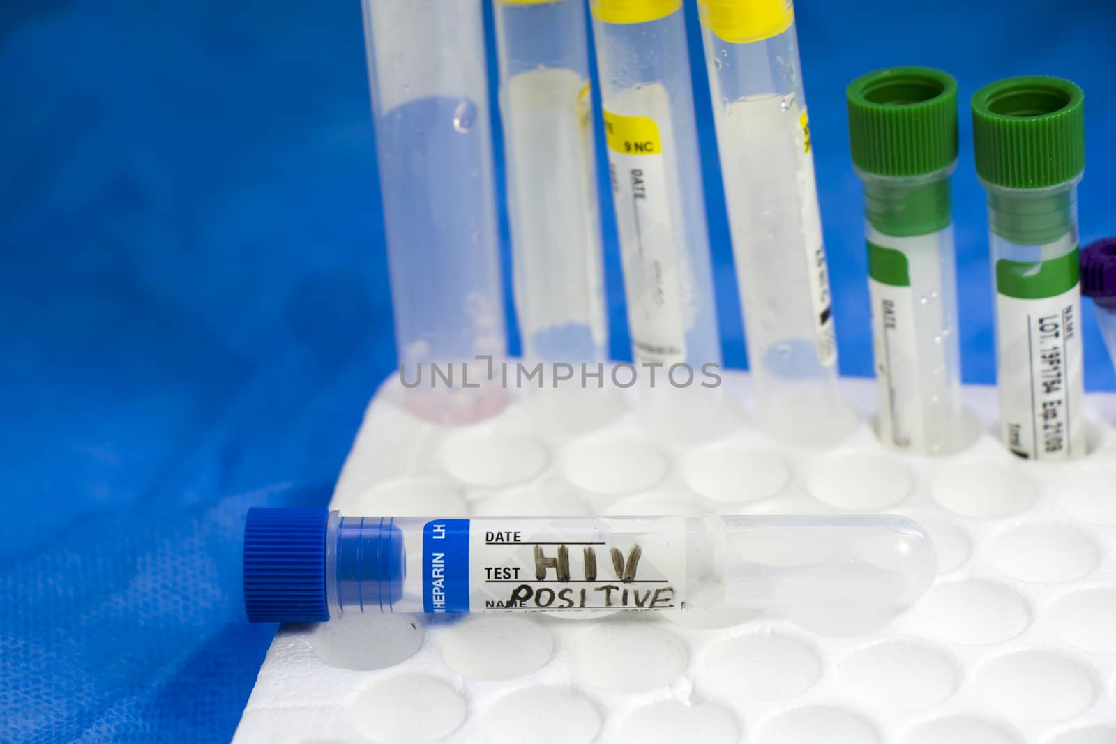 HIV and aids infection test, doctors face and hand holding tube with blood on the blue background. Studio shoot.
