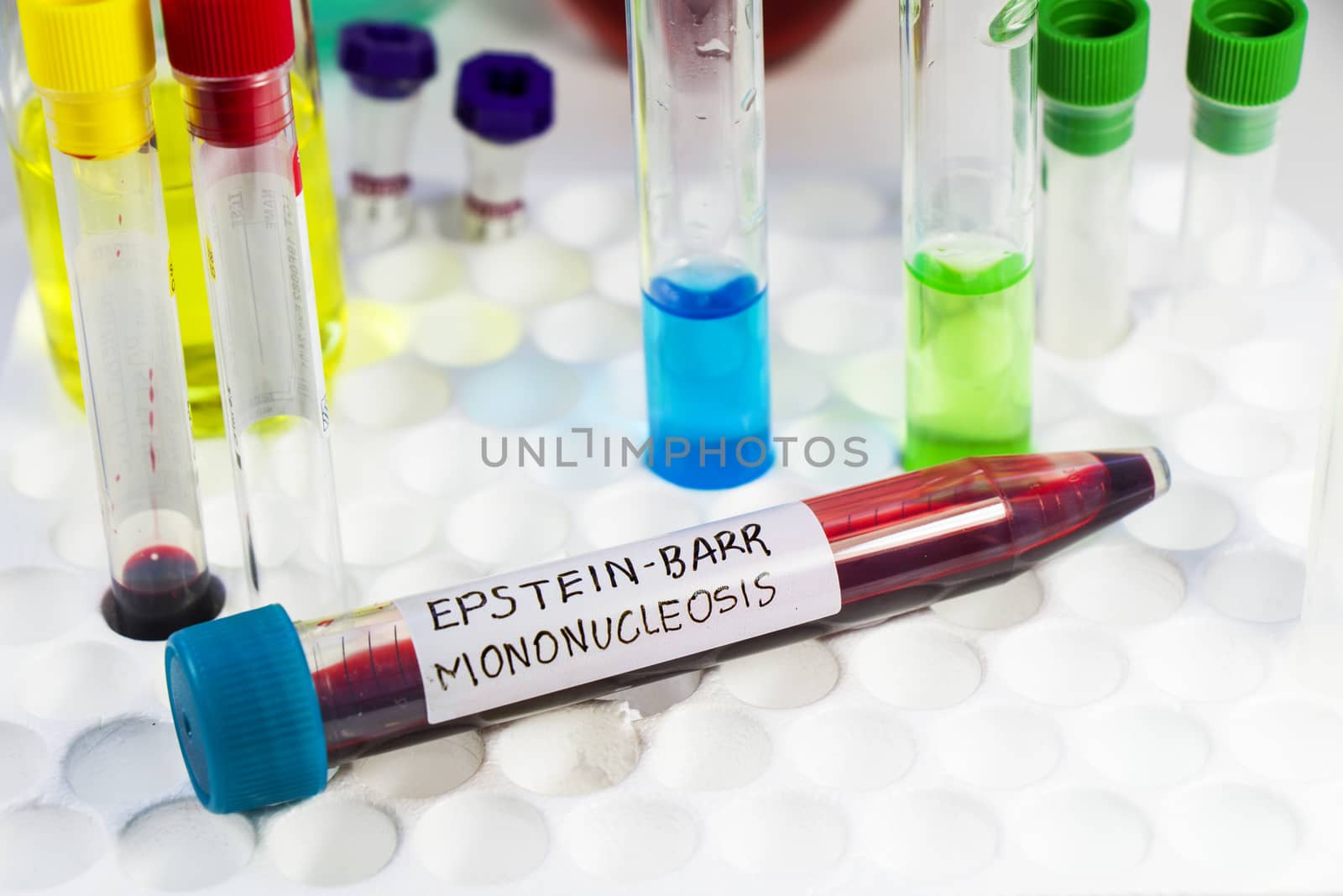Mononucleosis and Epstein-barr virus blood test sample in lab on the white background