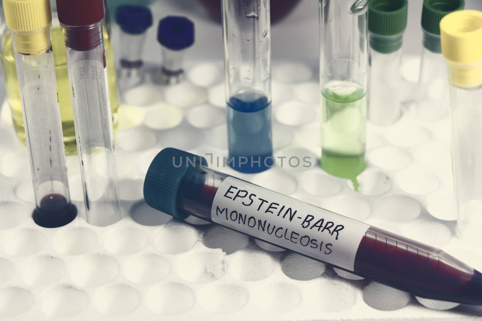 Mononucleosis and Epstein-barr virus blood test sample in lab by Taidundua
