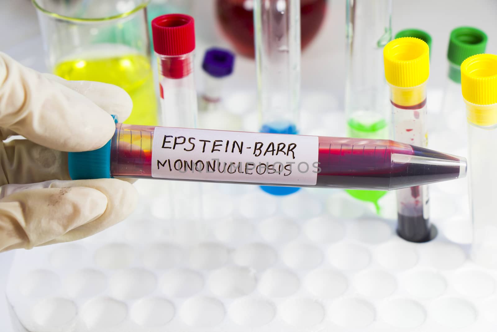Mononucleosis and Epstein-barr virus blood test sample in lab on the white background