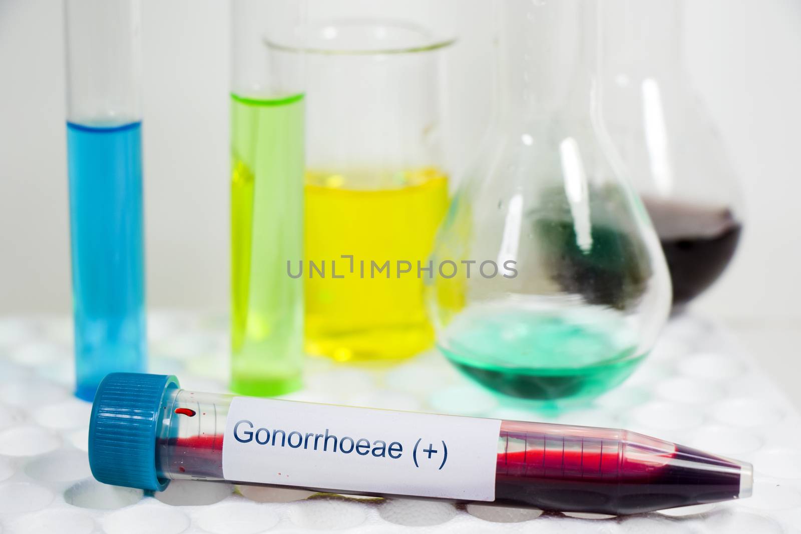 Gonorrhea blood test tube positive sample, laboratory diagnoses and chemical elements by Taidundua