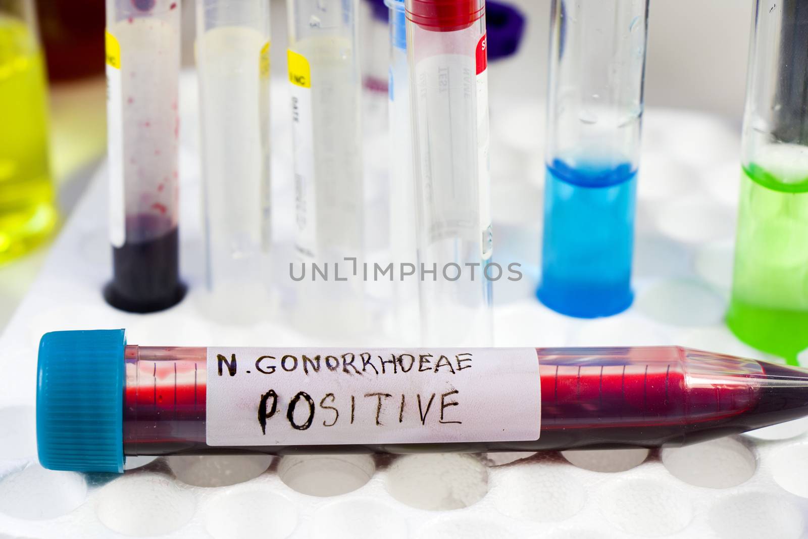 Gonorrhea blood test tube positive sample, laboratory diagnoses and chemical elements by Taidundua