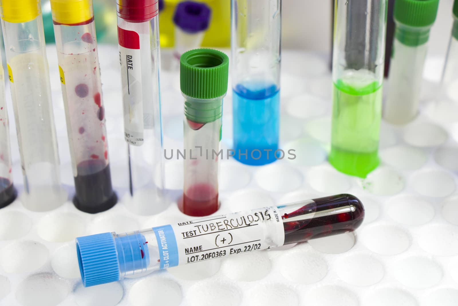 Tuberculosis blood test tube, laboratory and chemical instruments, diagnoses and research by Taidundua