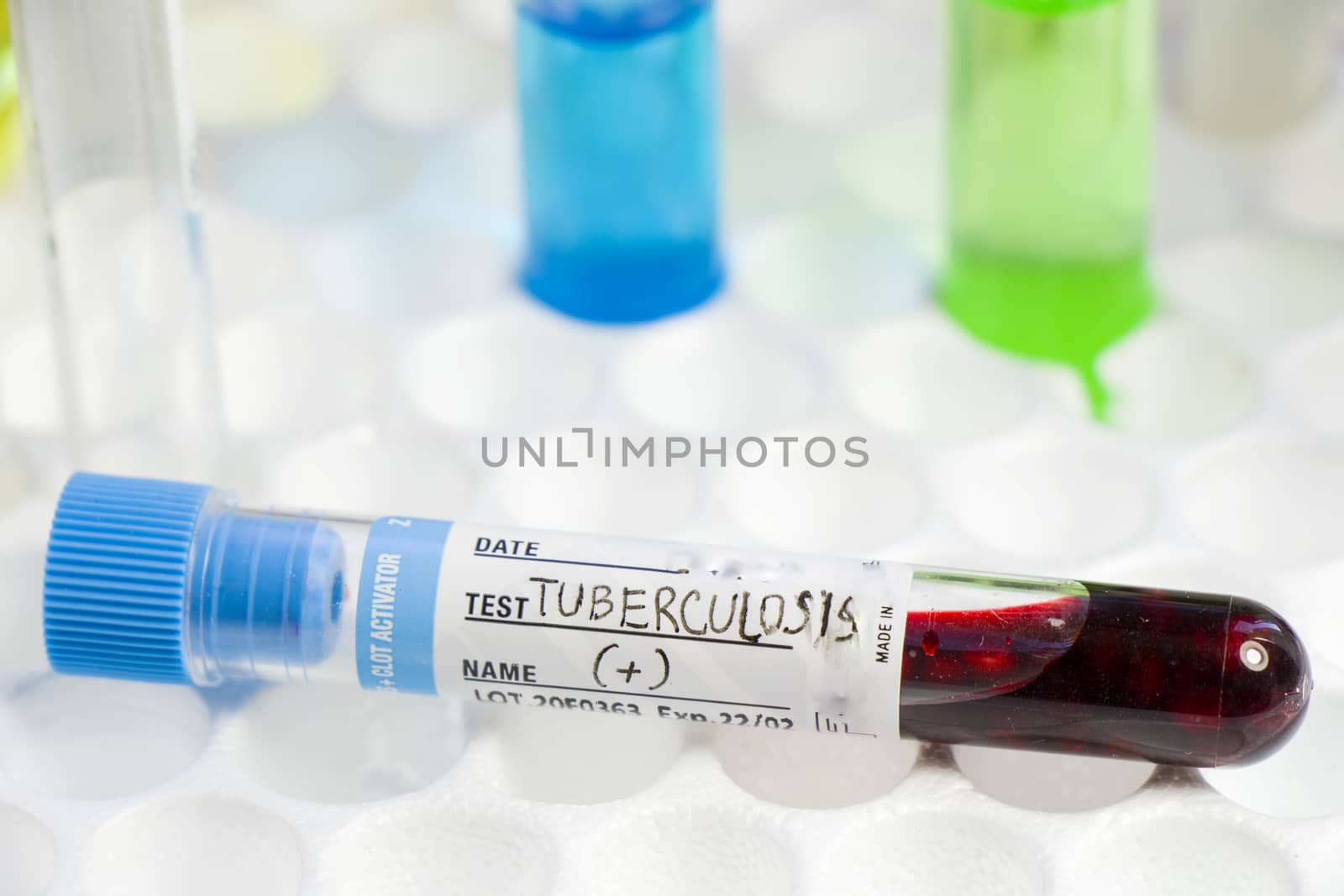 Tuberculosis blood test tube, laboratory and chemical instruments, diagnoses and research by Taidundua