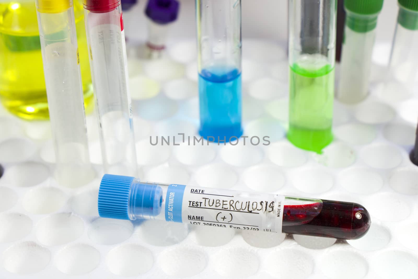 Tuberculosis blood test tube, laboratory and diagnoses