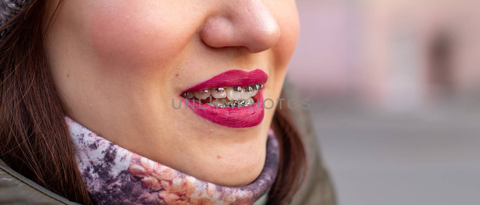Brasket system in a girl's smiling mouth, macro photography of teeth, close-up of lips