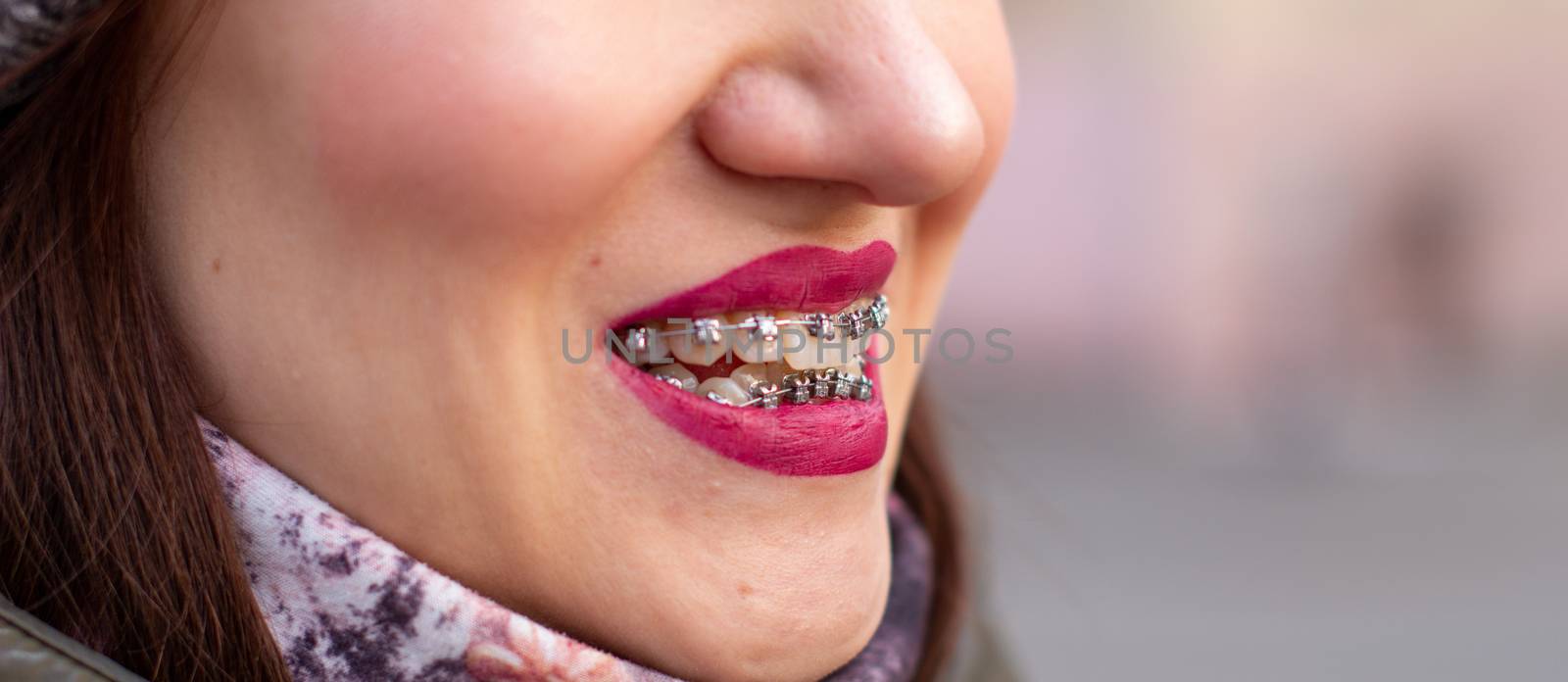 The brace system in the girl's smiling mouth, macro photography of teeth, close-up of red lips. Girl walking on the street