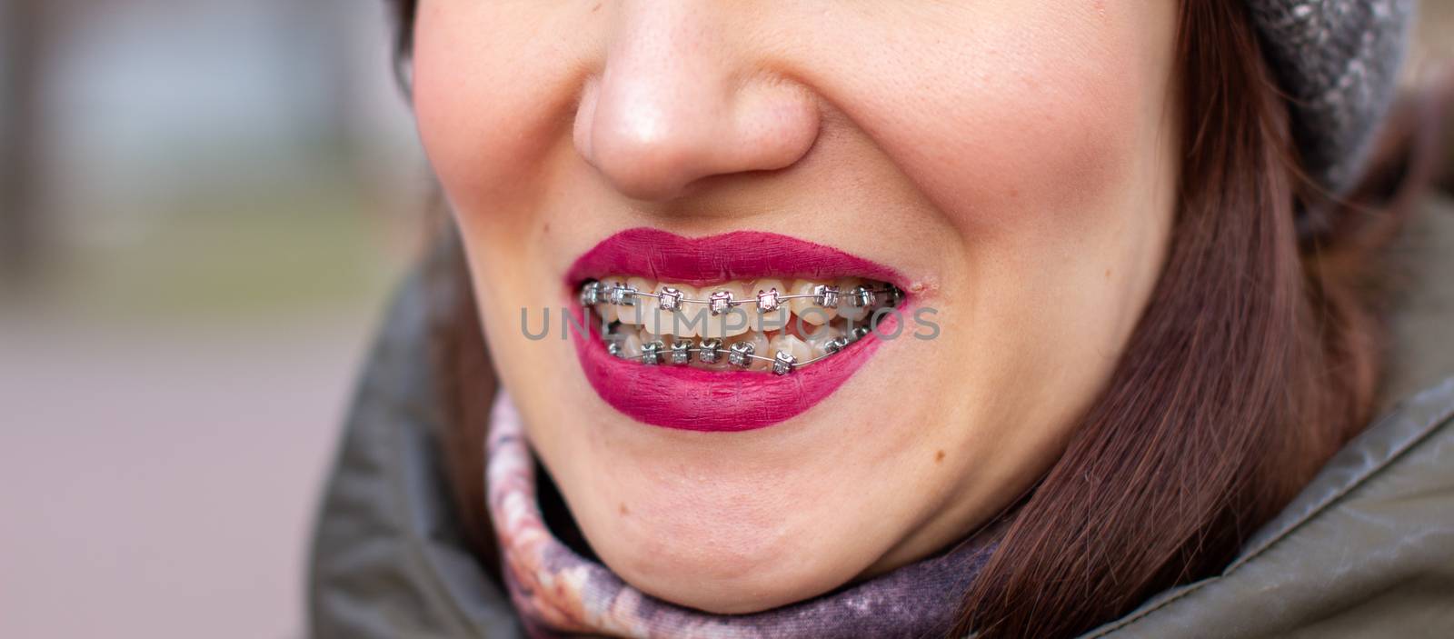The brace system in the girl's smiling mouth, macro photography of teeth, close-up of red lips. Girl walking on the street
