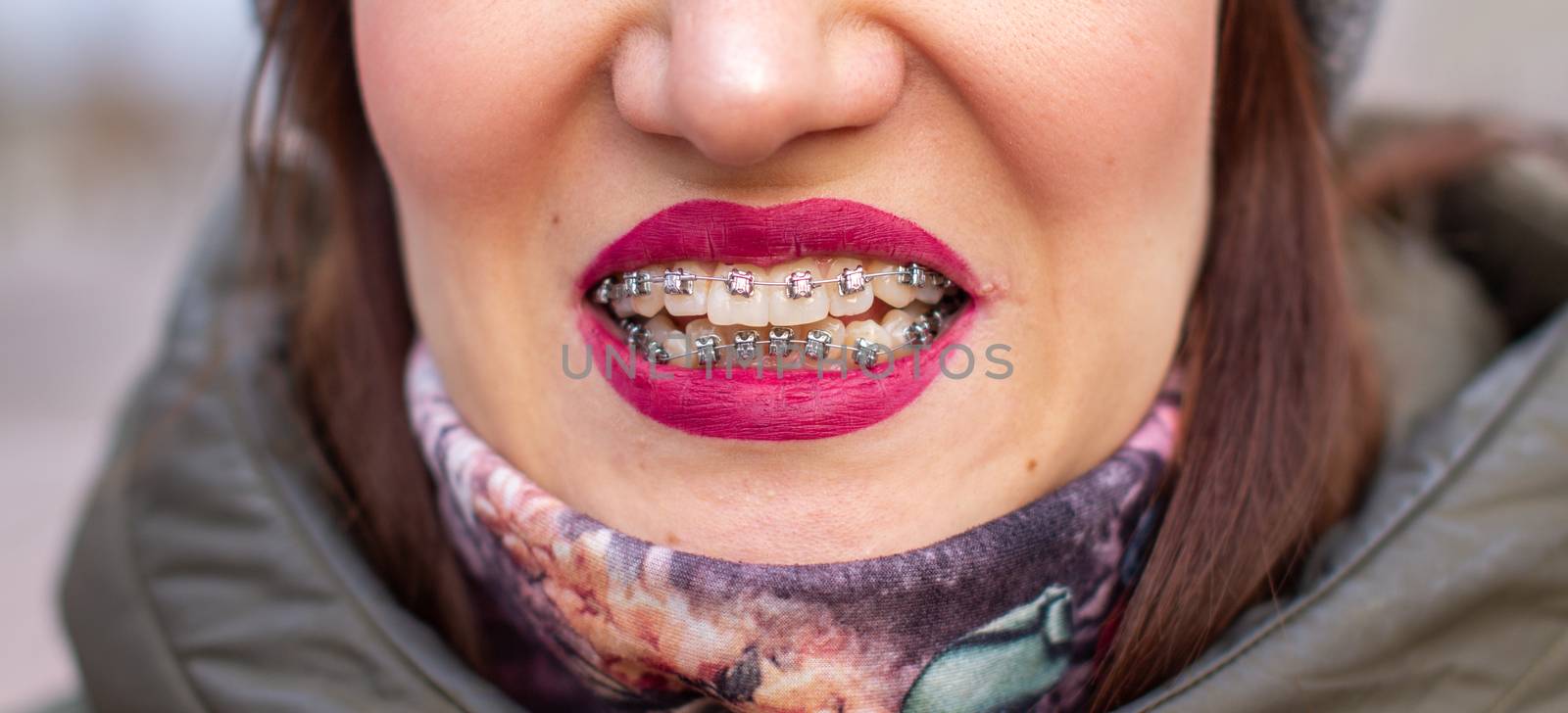 The brace system in the girl's smiling mouth, close-up of red lips by AnatoliiFoto