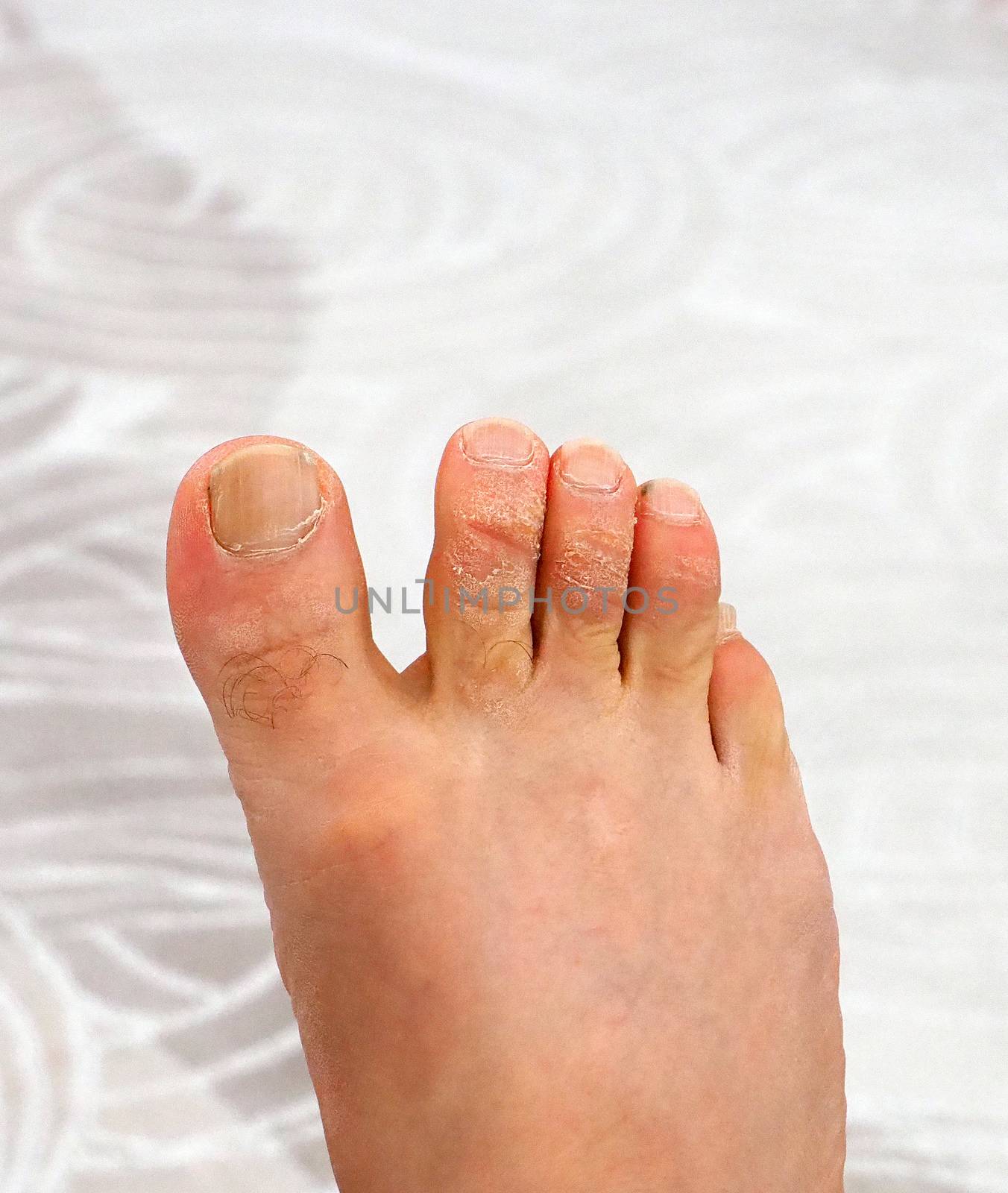 allergic skin rash on the toes, fungal disease of the toes,