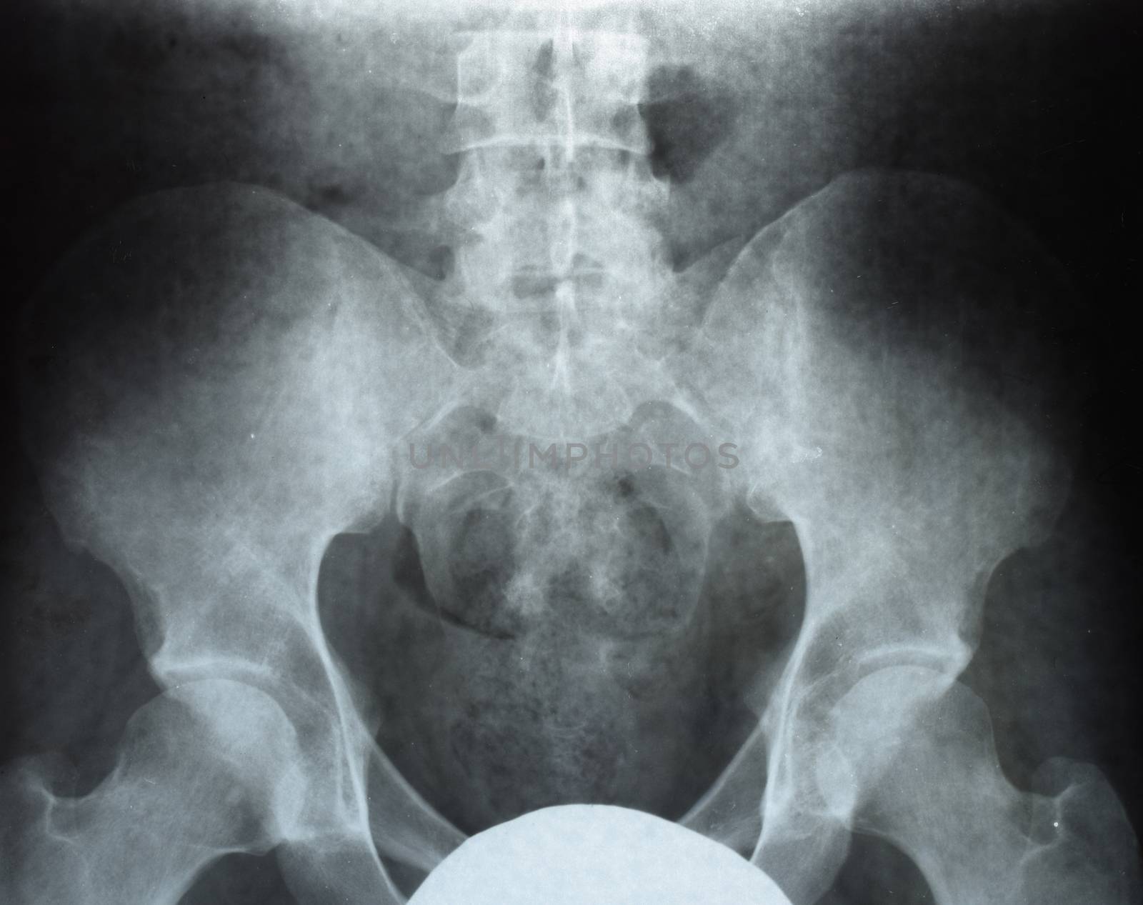 X-ray of the pelvis and sacrum. X-ray image.