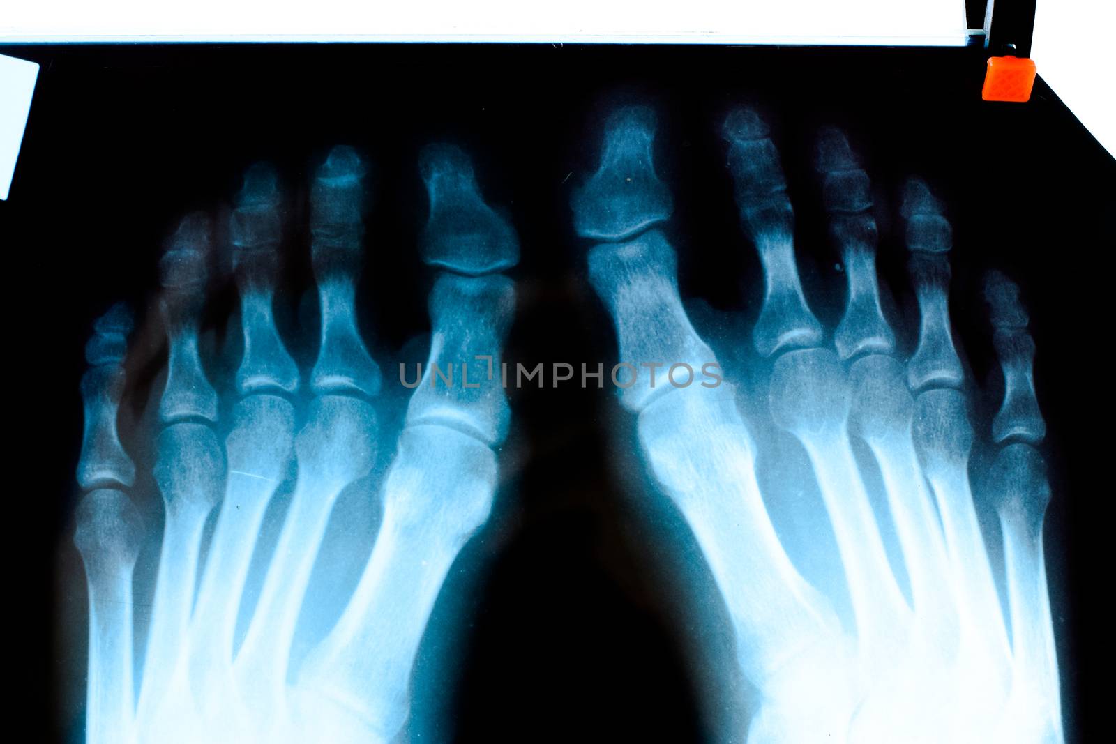 X-ray of toes. Foot on X-ray. bone research