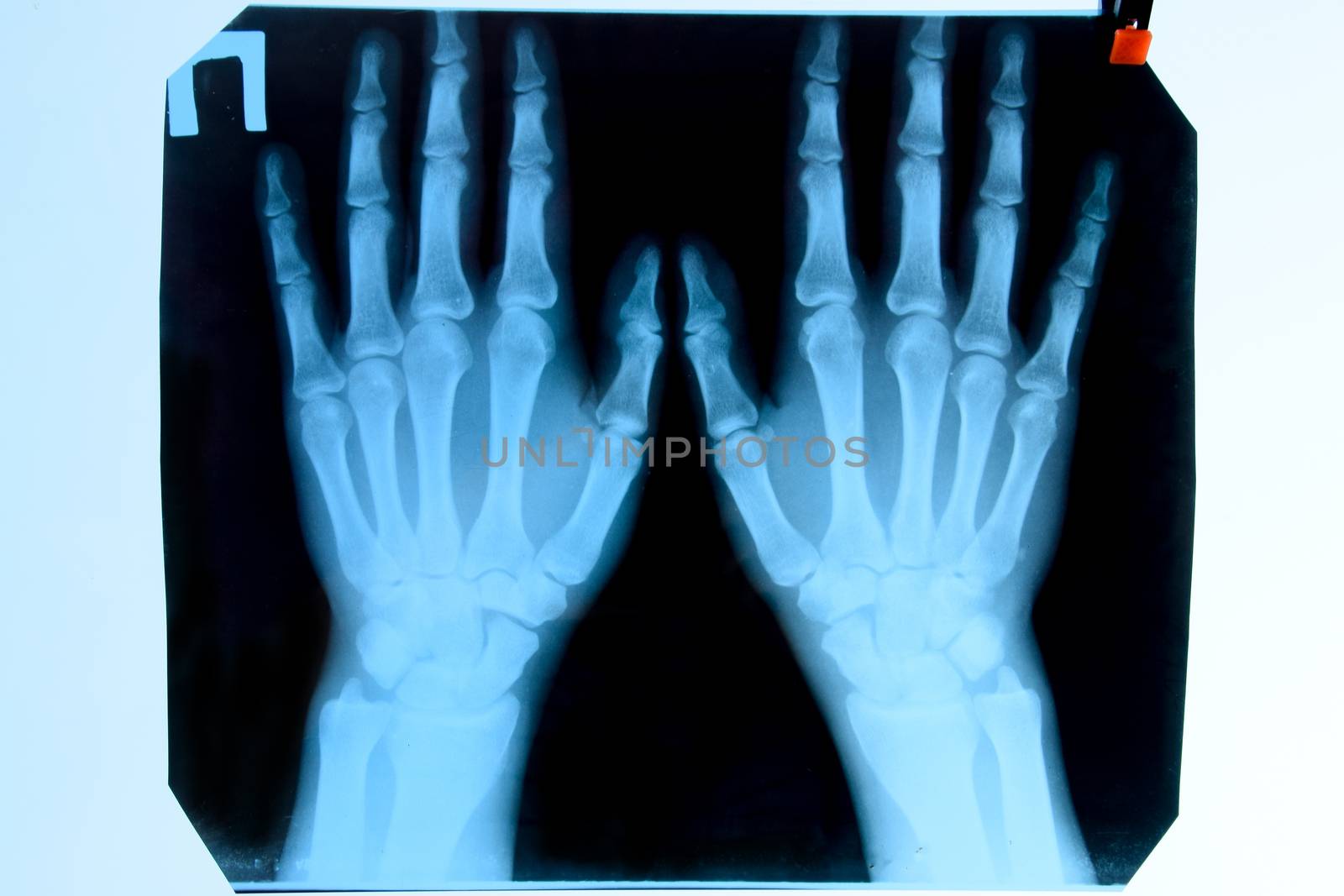 X-ray of the hands, a picture of the bones of the hands on the x-ray.