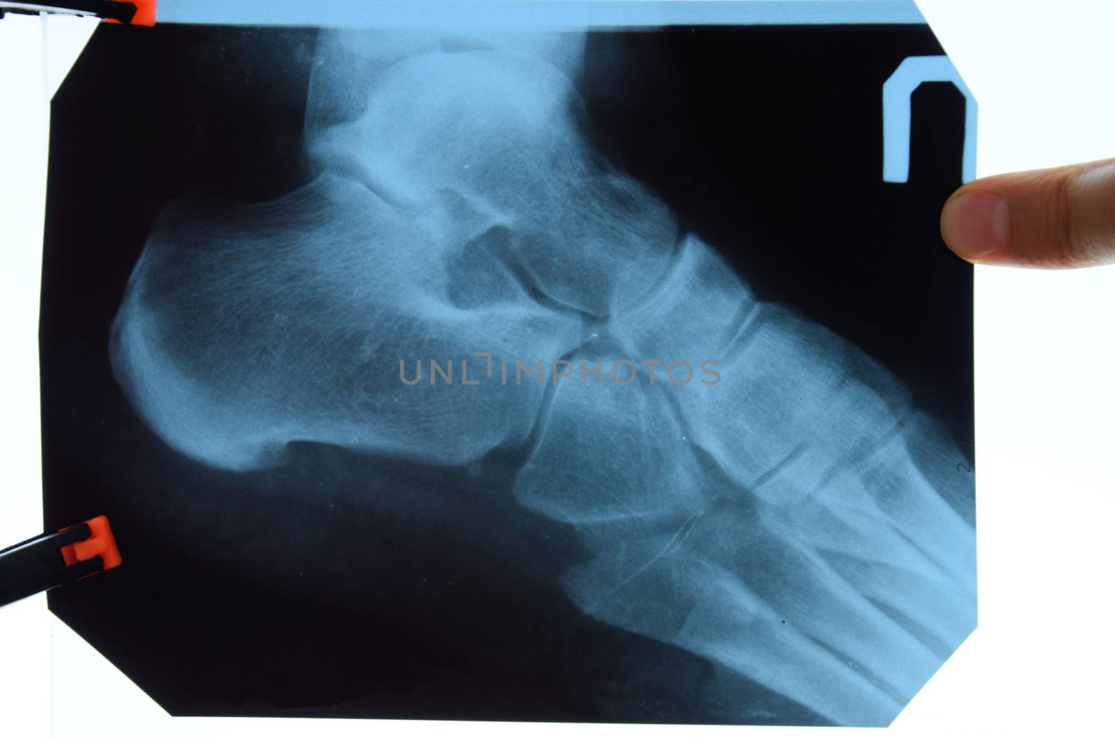 X-ray of feet and heel bones. X-ray picture of bones.