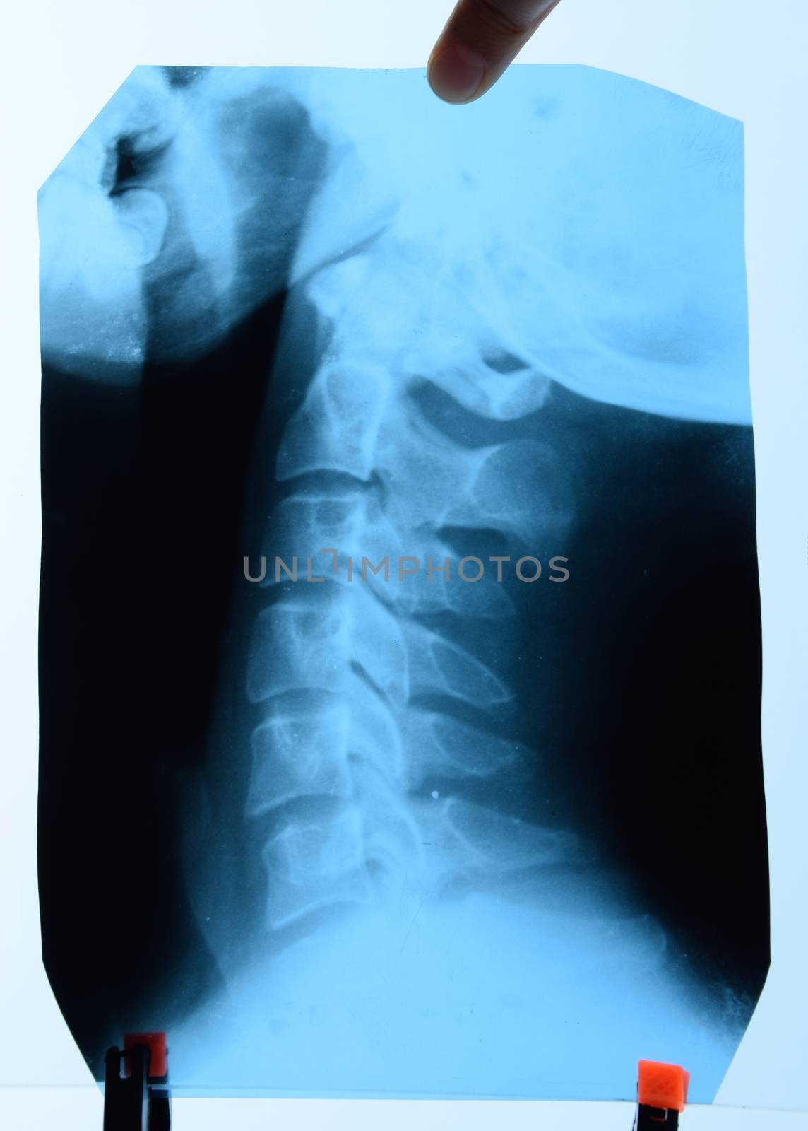 X-ray of the cervical vertebrae. X-ray image of the cervical spine.
