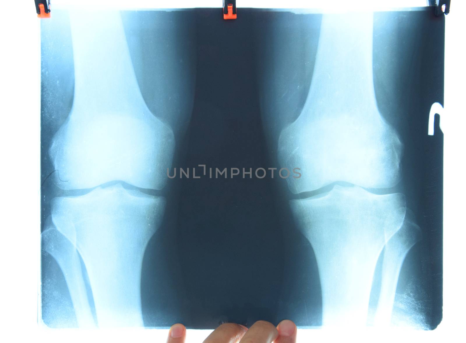 X-ray of the knee joints, a picture of the bones of the knee on the x-ray.