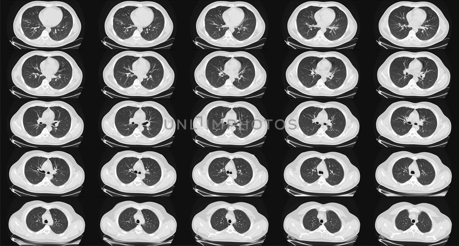 Computed tomography of the lungs in a healthy adult man. Normal lungs ct scan in horizontal or transverse plane. Sequaentional. May be part of COVID-19 diagnostic.