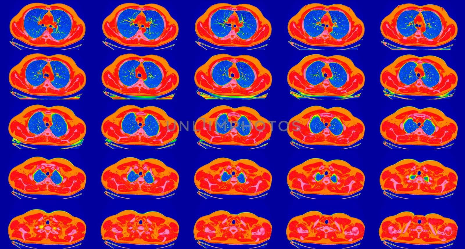 Computed tomography of the lungs in a healthy adult man. Normal lungs ct scan in horizontal or transverse plane, spectral toned. Sequaentional. May be part of COVID-19 diagnostic.