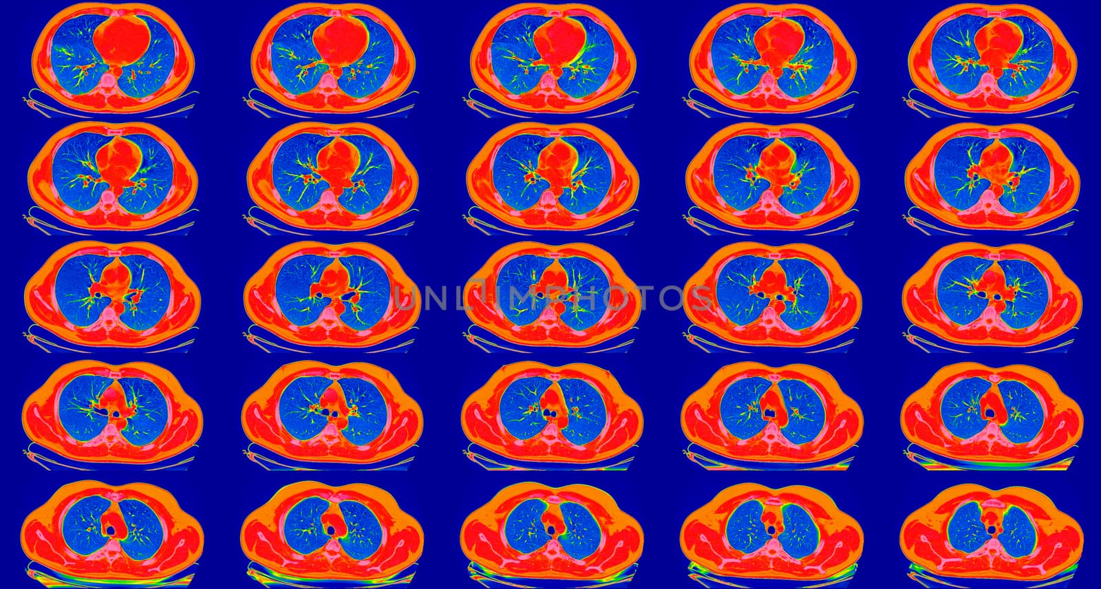 Computed tomography of the lungs in a healthy adult man. Normal lungs ct scan in horizontal or transverse plane, spectral toned. Sequaentional. May be part of COVID-19 diagnostic.