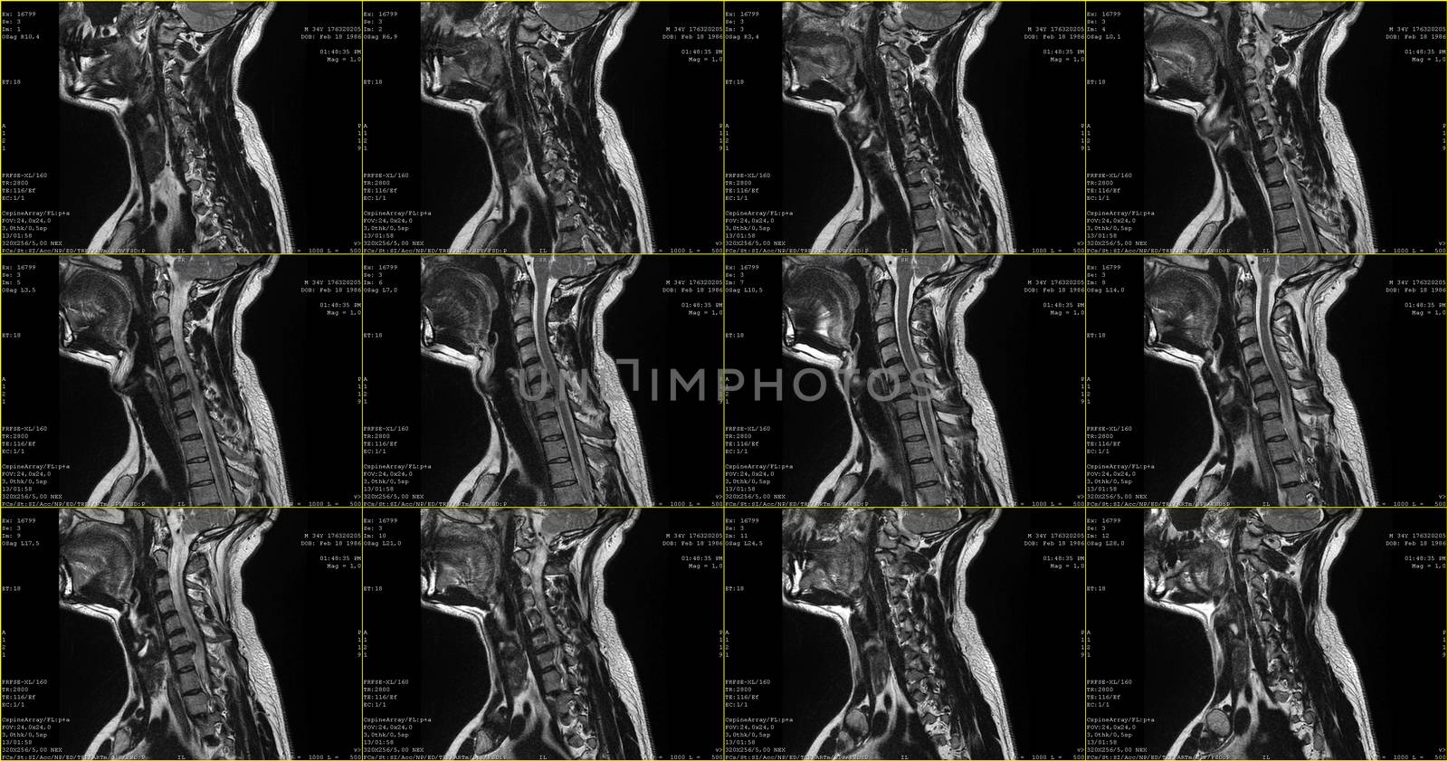 set of sagittal MRI scans of neck area of 34 years old caucasian male with herniaset of MRI scans of neck area of caucasian male with bilateral paramedial, with a left accent, extrusion of the C6-C7 segment with left-sided C7 radiculopathy, moderate paresis of the triceps of the left hand.