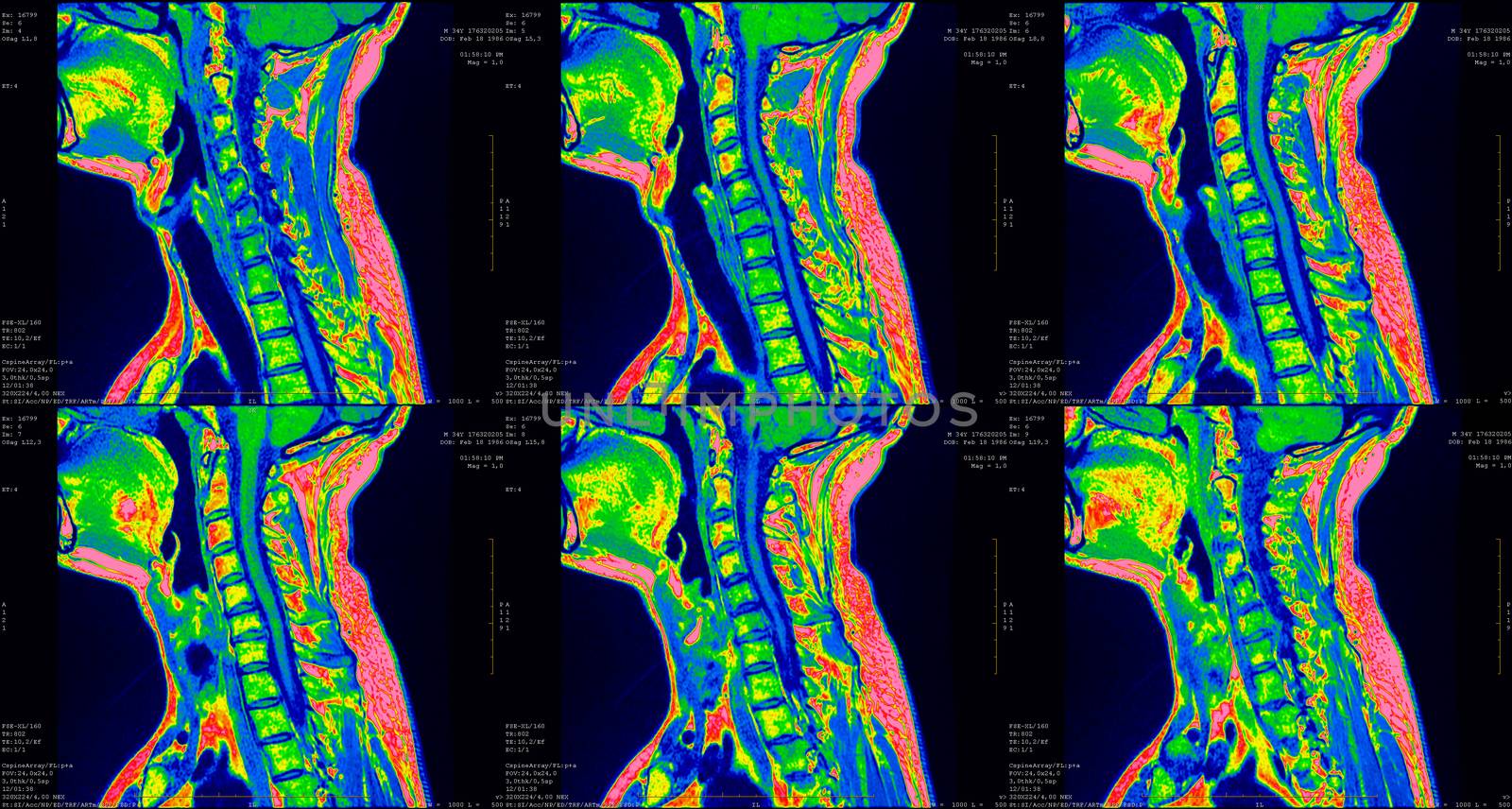 set of 6 green colored sagittal MRI scans of neck area of 34 years old caucasian male with herniaset of MRI scans of neck area of caucasian male with bilateral paramedial, with a left accent, extrusion of the C6-C7 segment with left-sided C7 radiculopathy, moderate paresis of the triceps of the left hand.