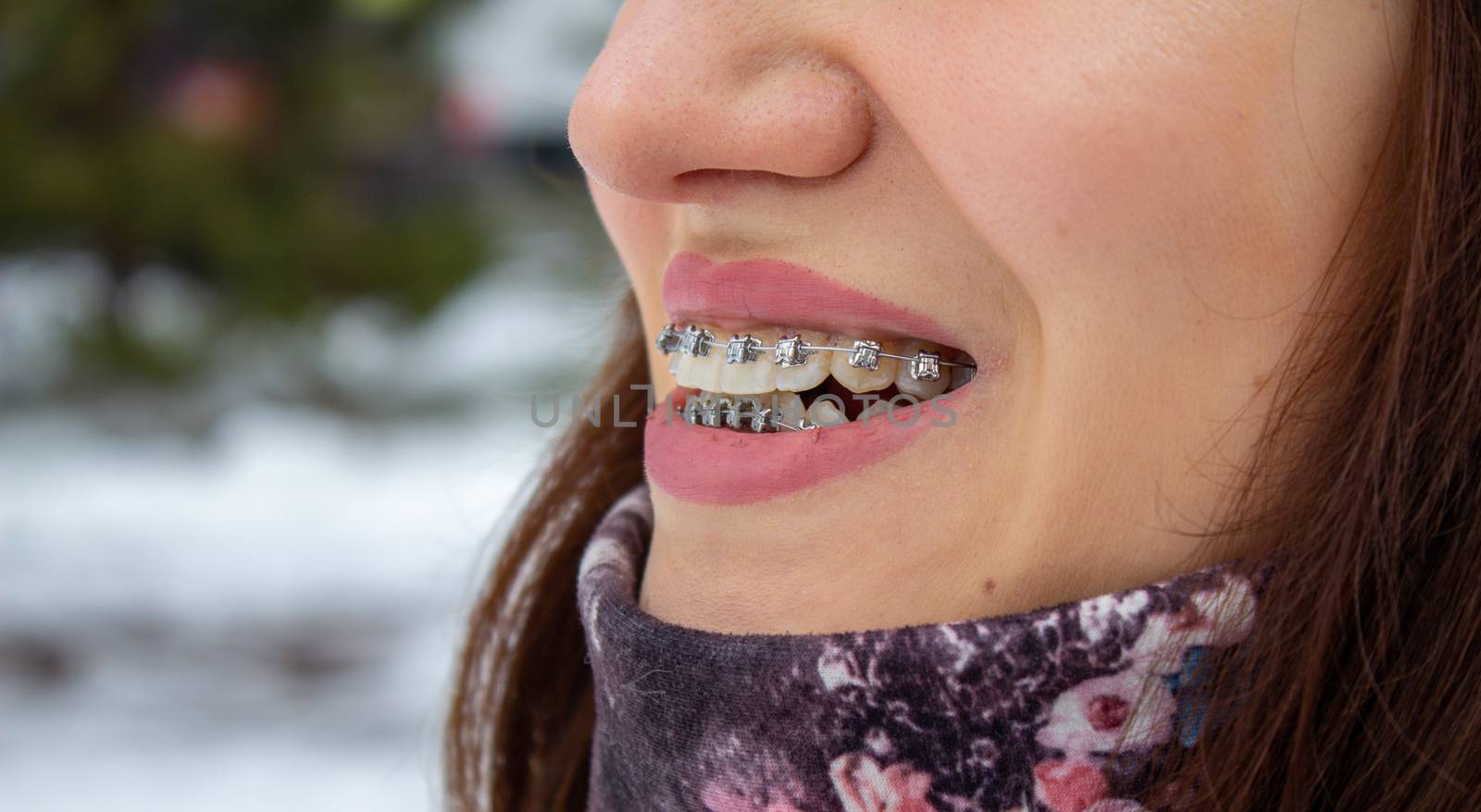 Brasket system in a girl's smiling mouth, macro photography of teeth. large face and painted lips