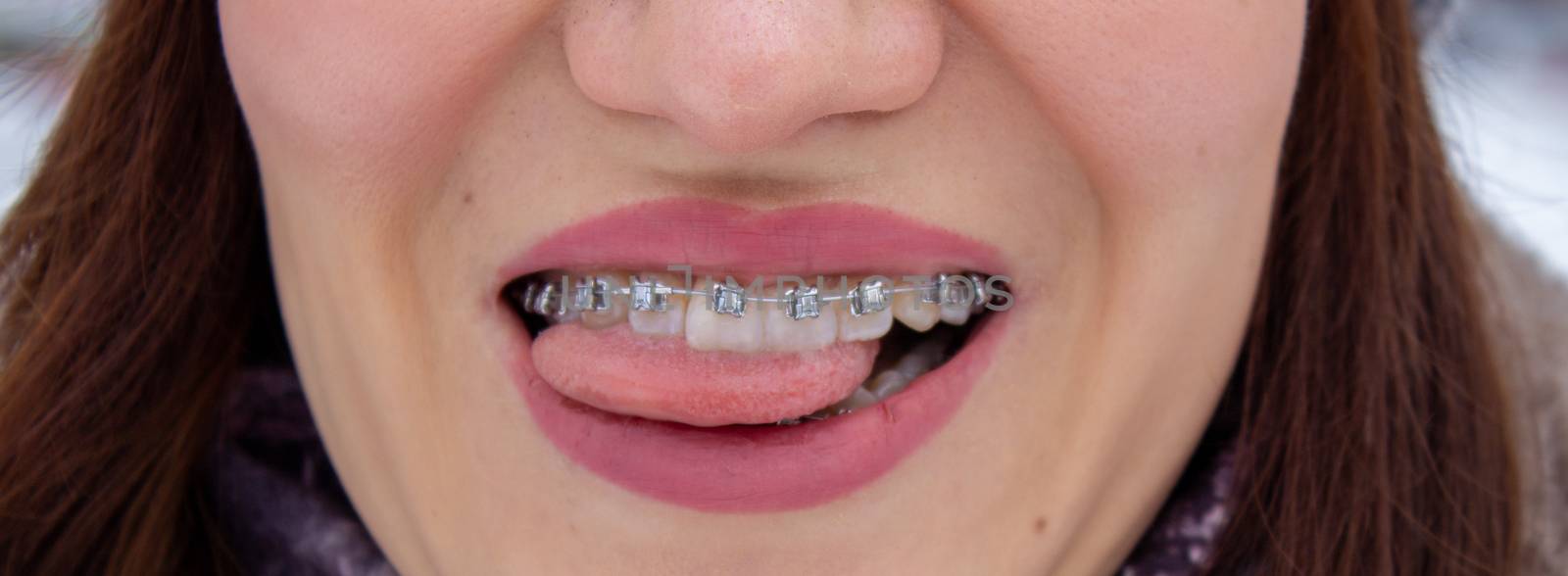 Braces on the girl's teeth smiling, macro photo teeth, close-up lips,  by AnatoliiFoto
