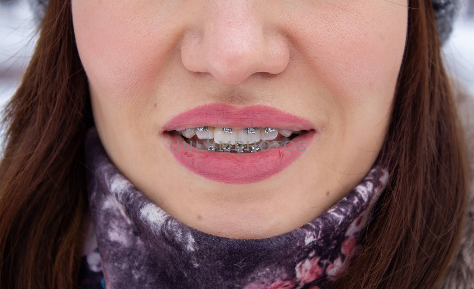 Brasket system in a girl's smiling mouth, macro photography of teeth. large face and painted lips. Braces on the girl's teeth