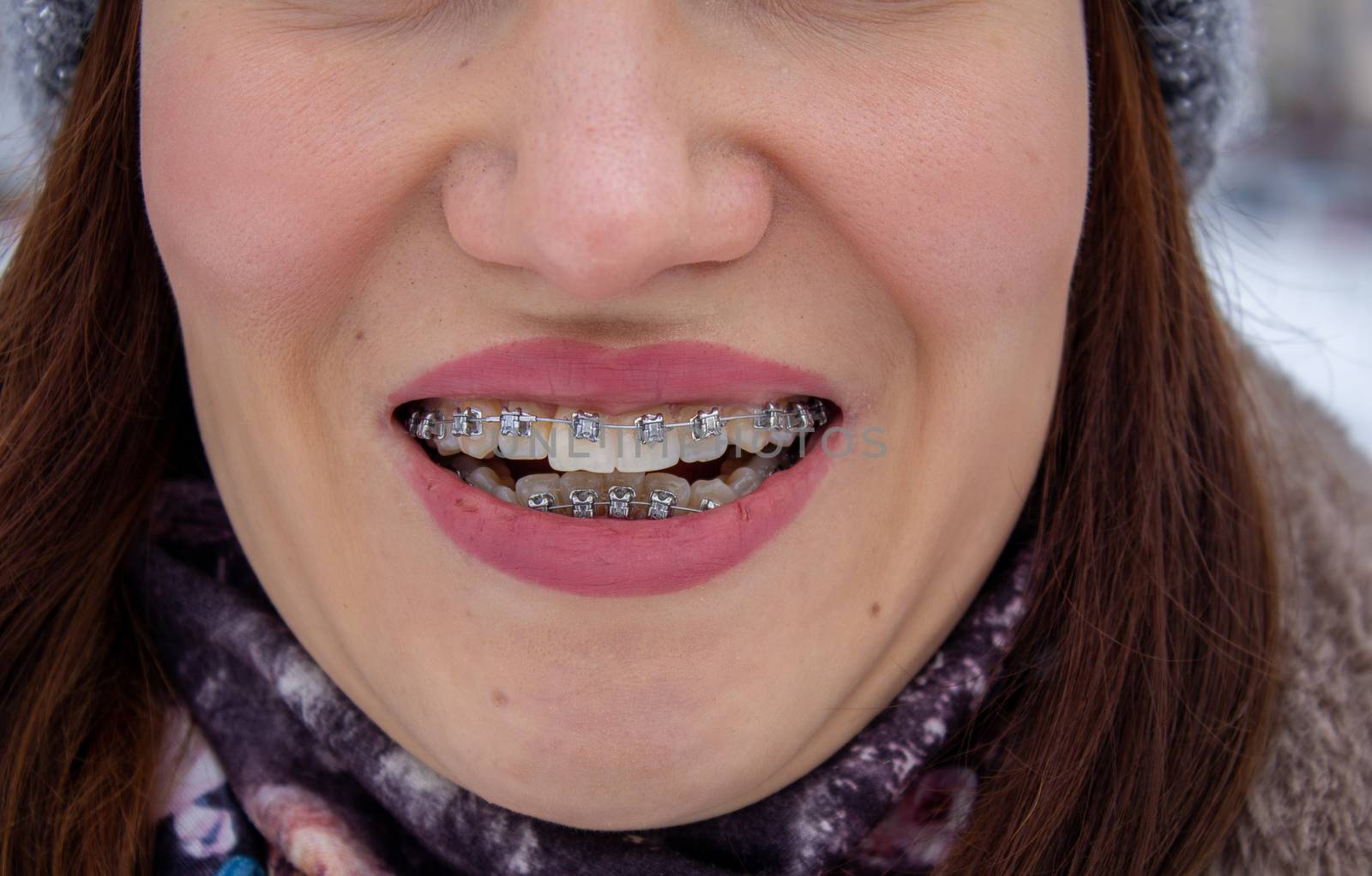 Brasket system in a girl's smiling mouth, macro photography of teeth. large face and painted lips. Braces on the girl's teeth