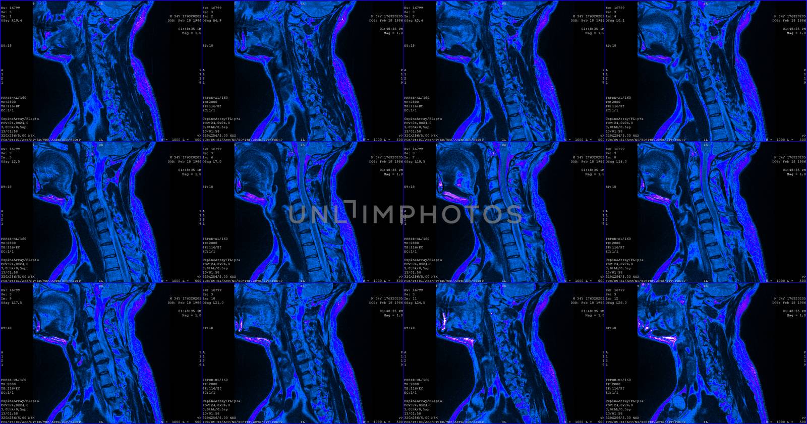 set of 12 blue sagittal MRI scans of neck area of 34 years old caucasian male with herniaset of MRI scans of neck area of caucasian male with bilateral paramedial, with a left accent, extrusion of the C6-C7 segment with left-sided C7 radiculopathy, moderate paresis of the triceps of the left hand.
