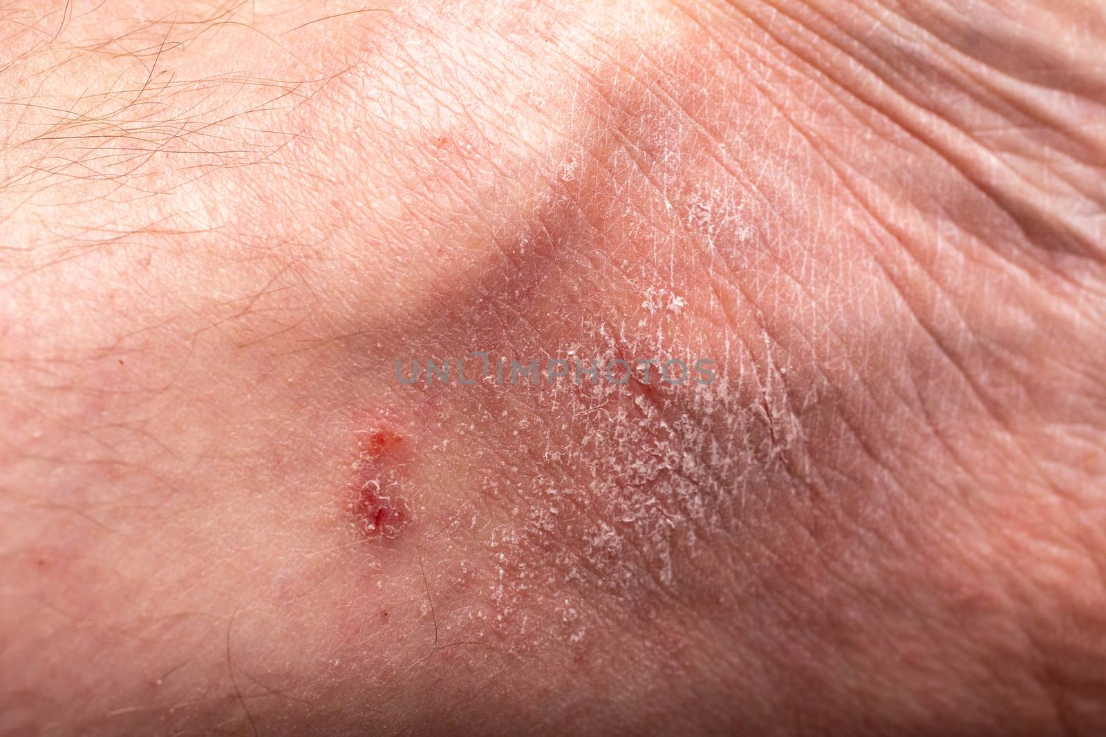 Close up dermatitis on the foot skin. Ill allergic peeling skin of patient.