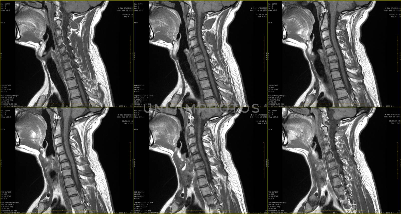 set of 6 sagittal MRI scans of neck area of 34 years old caucasian male with herniaset of MRI scans of neck area of caucasian male with bilateral paramedial, with a left accent, extrusion of the C6-C7 segment with left-sided C7 radiculopathy, moderate paresis of the triceps of the left hand.