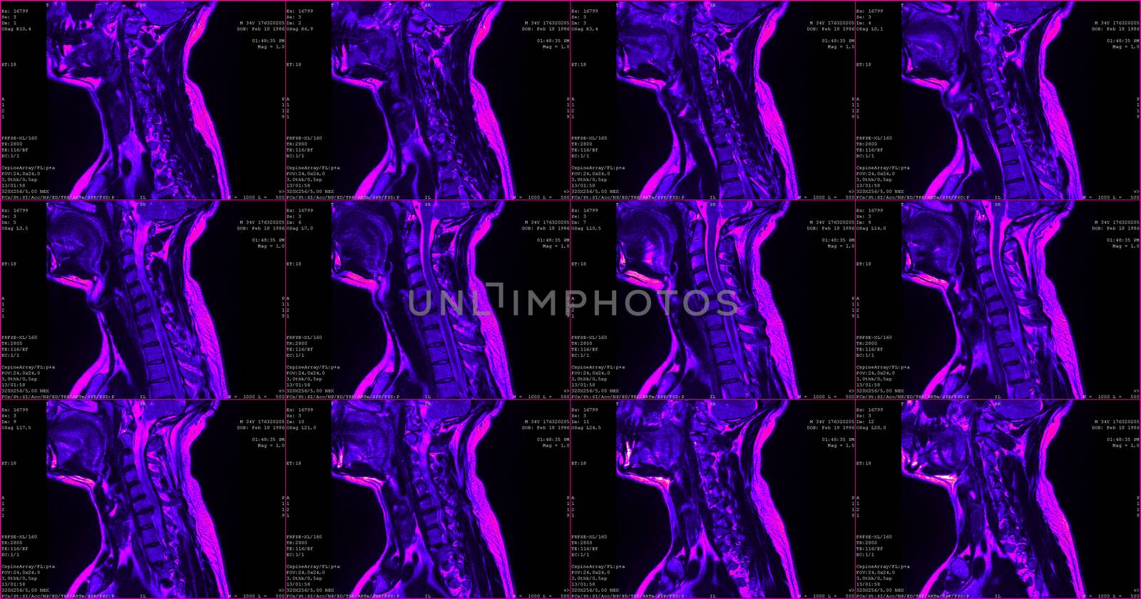 set of 6 green colored sagittal MRI scans of neck area of 34 years old caucasian male with herniaset of MRI scans of neck area of caucasian male with bilateral paramedial, with a left accent, extrusion of the C6-C7 segment with left-sided C7 radiculopathy, moderate paresis of the triceps of the left hand.