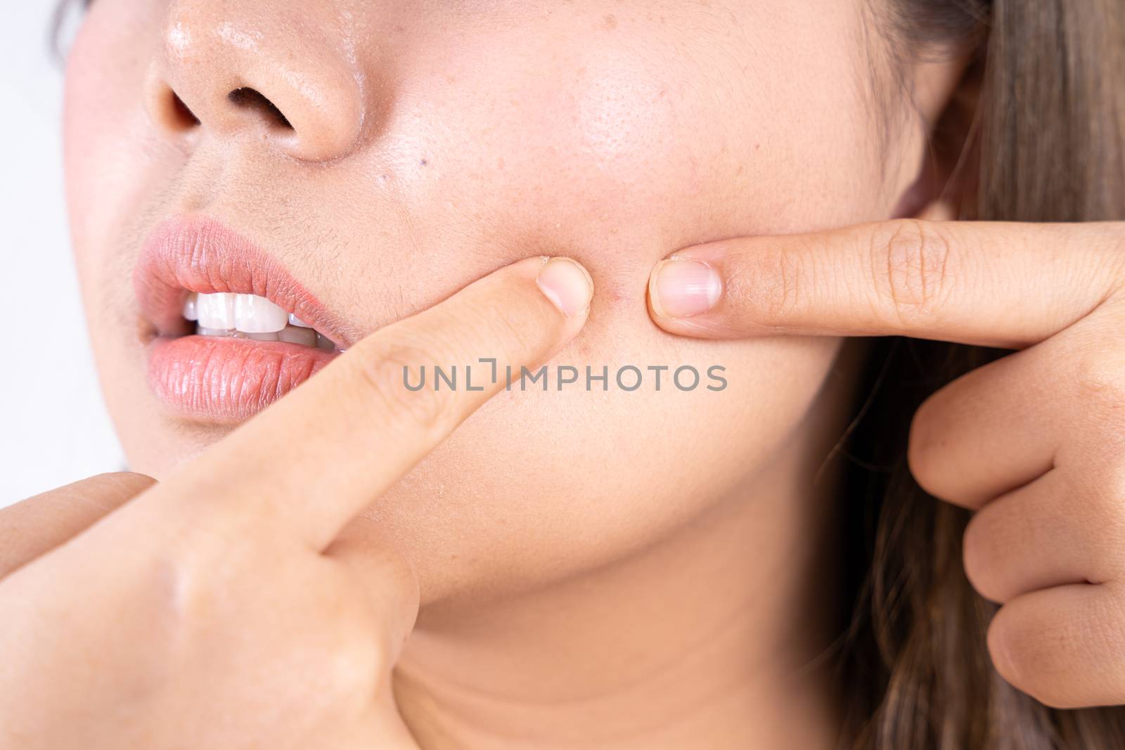 Close up woman squeezing her pimple, removing acne from her face. Skincare and skin problem concept.