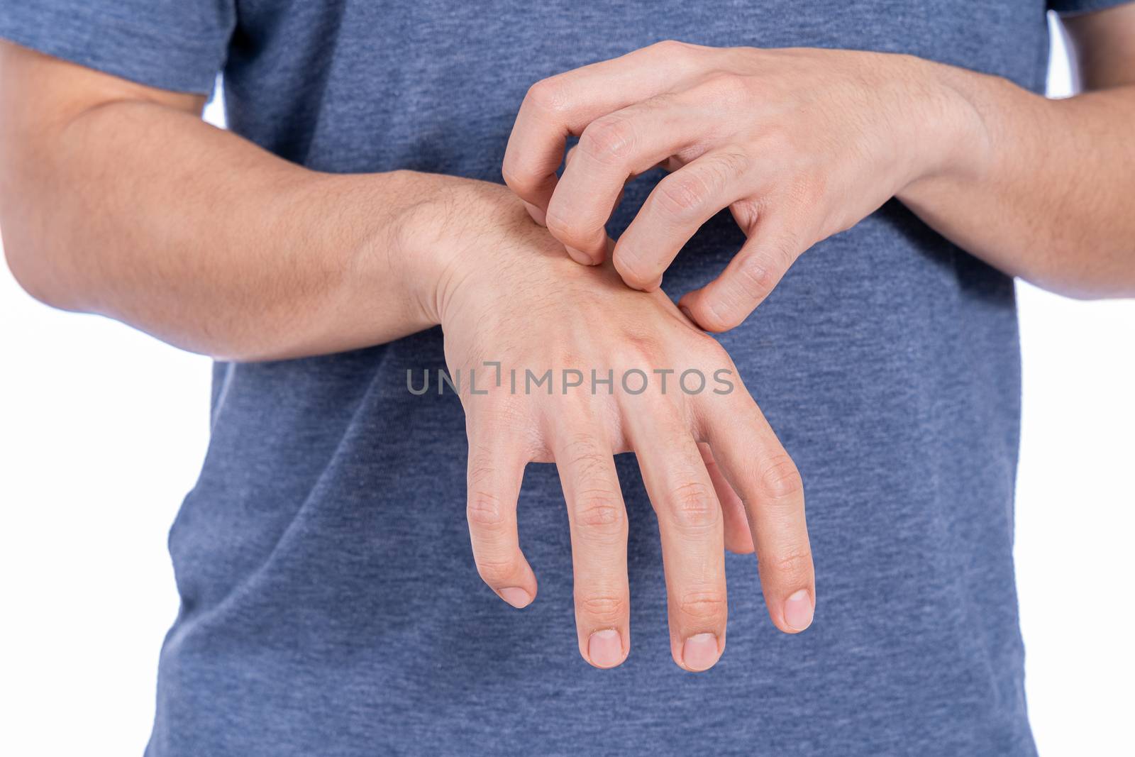 Male scratching his hand isolated white background. Medical, healthcare for advertising concept.