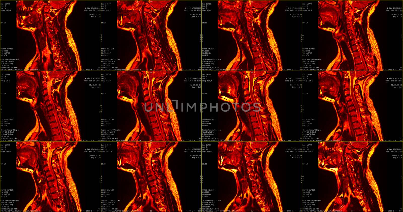 set of 12 red colored sagittal MRI scans of neck area of 34 years old caucasian male with herniaset of MRI scans of neck area of caucasian male with bilateral paramedial, with a left accent, extrusion of the C6-C7 segment with left-sided C7 radiculopathy, moderate paresis of the triceps of the left hand.