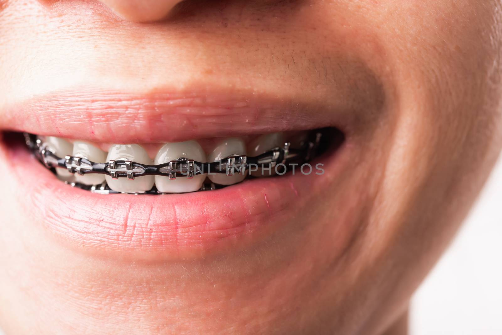 Woman smile show mouth with white teeth with black brackets brac by Sorapop