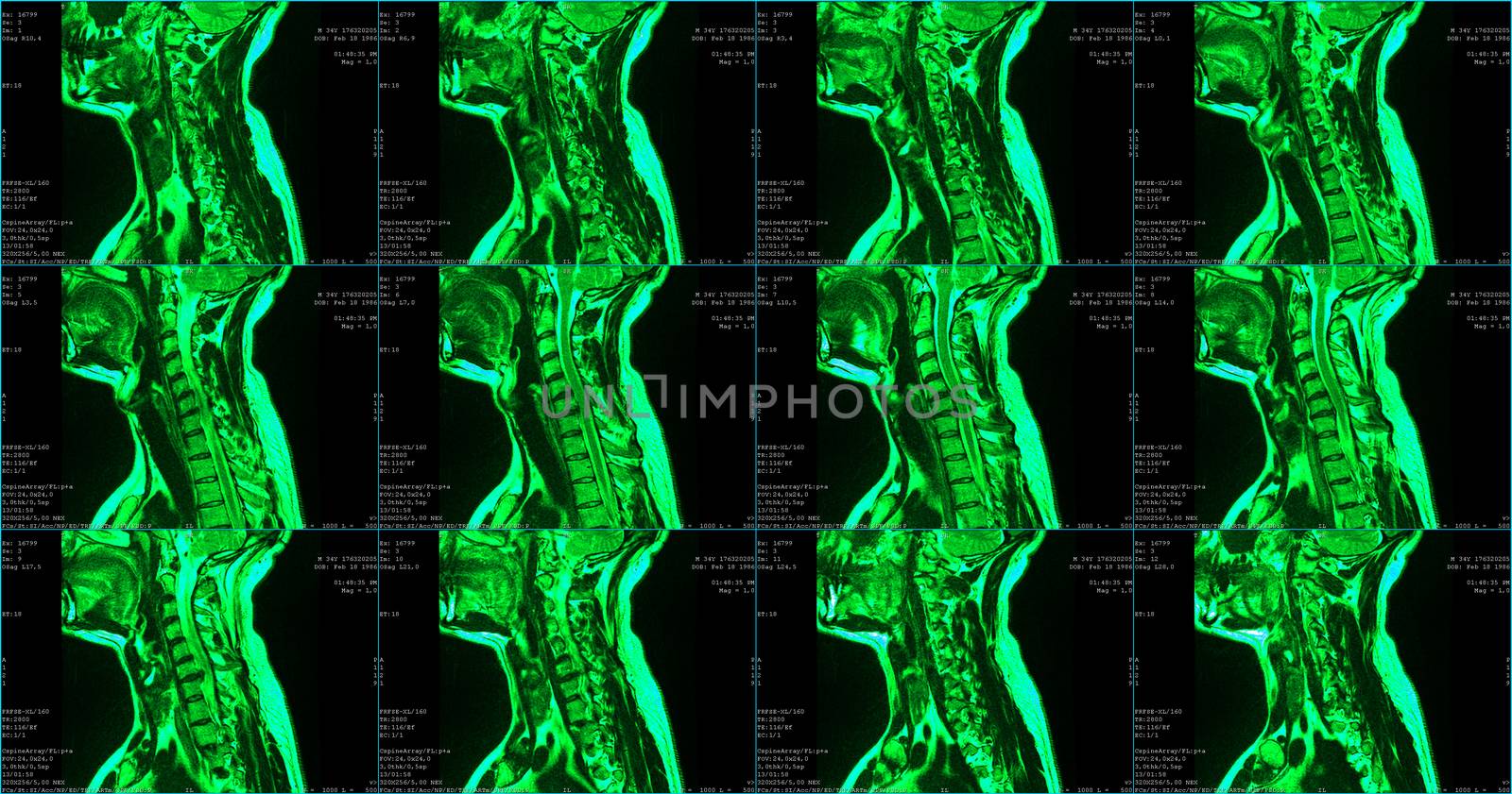 set of 6 green colored sagittal MRI scans of neck area of 34 years old caucasian male with herniaset of MRI scans of neck area of caucasian male with bilateral paramedial, with a left accent, extrusion of the C6-C7 segment with left-sided C7 radiculopathy, moderate paresis of the triceps of the left hand.