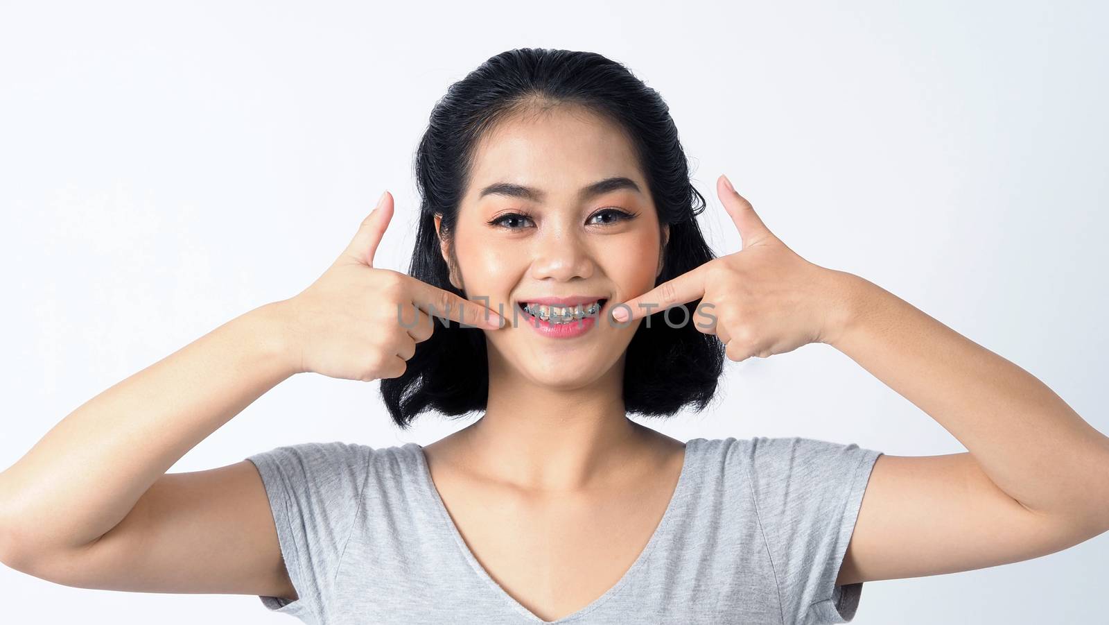 Asian teen facial with braces smiling to camera to show orthodon by gnepphoto