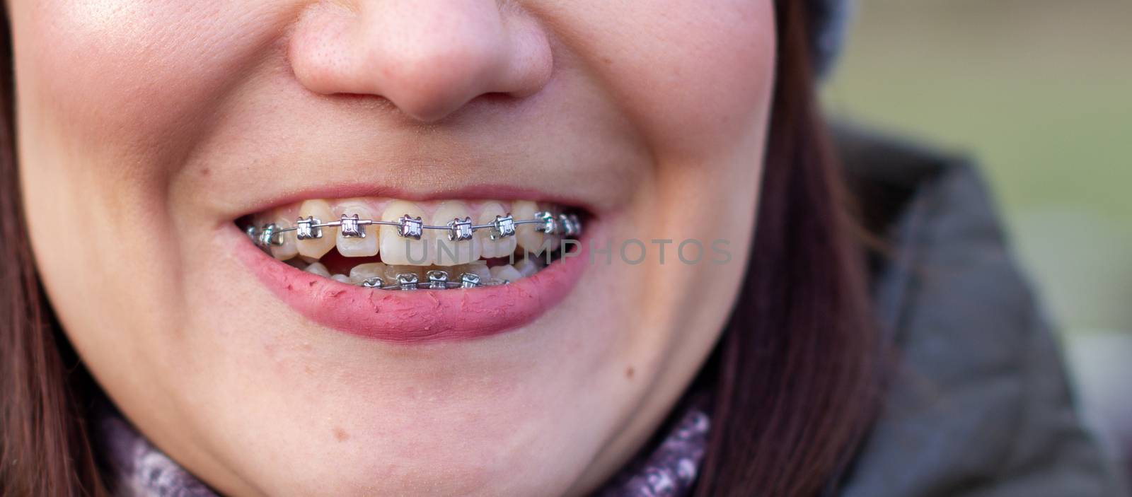 Brasket system in a girl's smiling mouth, macro photography of teeth. large face and painted lips. Braces on the girl's teeth