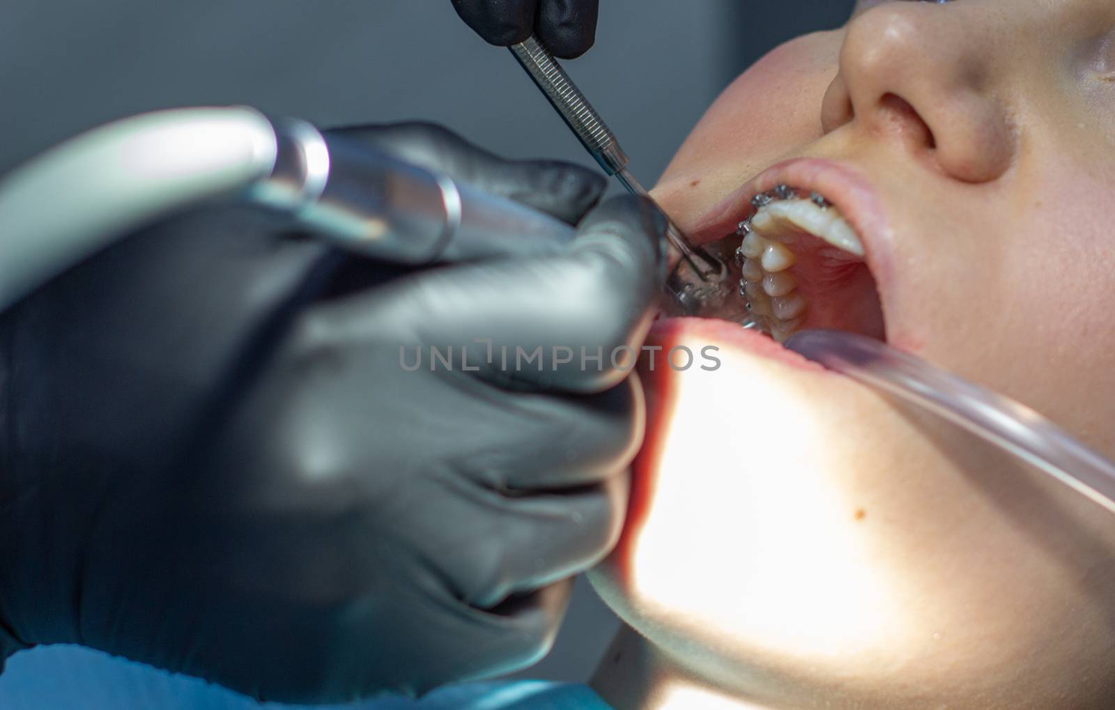 Beautiful woman in dental chair during procedure of installing braces to upper and lower teeth. orthodontist in clinic. Dentist and assistant working together, dental tools in their hands. Top view.