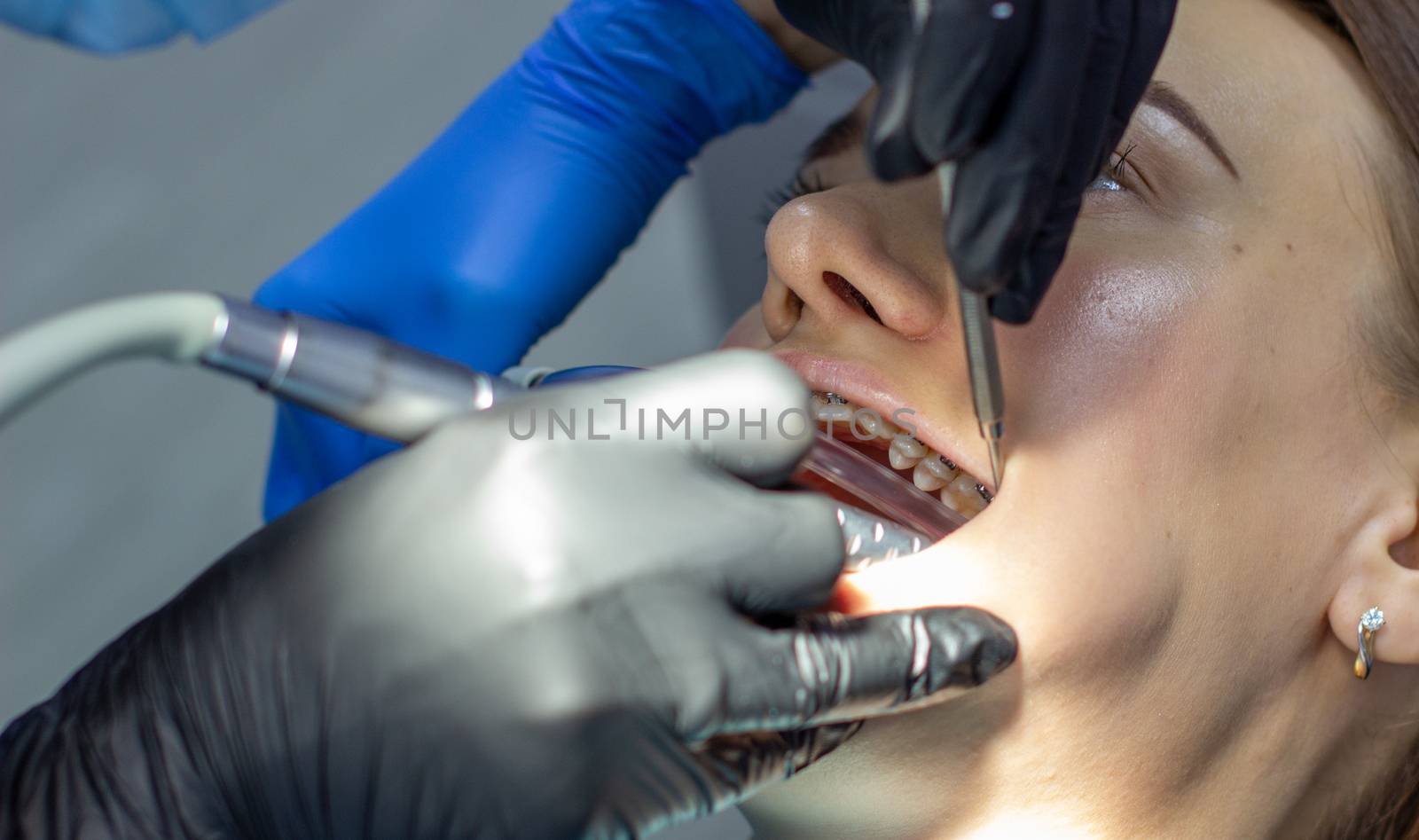 Beautiful woman in dental chair during procedure of installing braces to upper and lower teeth. Dentist and assistant working together, dental tools in their hands. Top view. Concept of dentistry