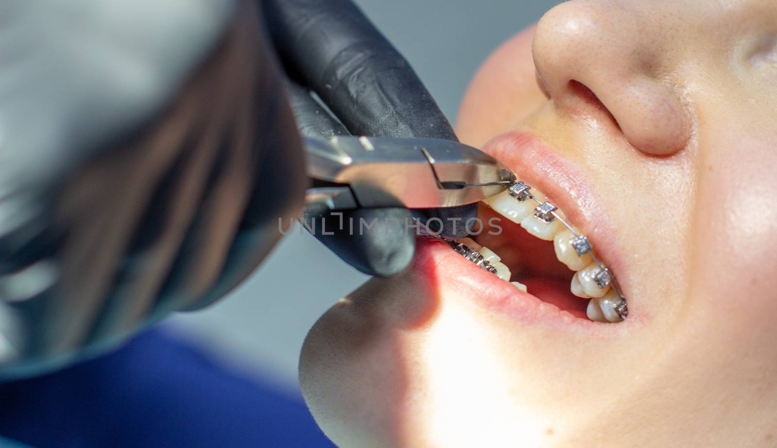 A woman with dental braces visits an orthodontist in the clinic, in a dental chair. during the procedure of installing the arch of braces on the upper and lower teeth. The dentist is wearing gloves and has dental instruments in his hands. The concept of dentistry