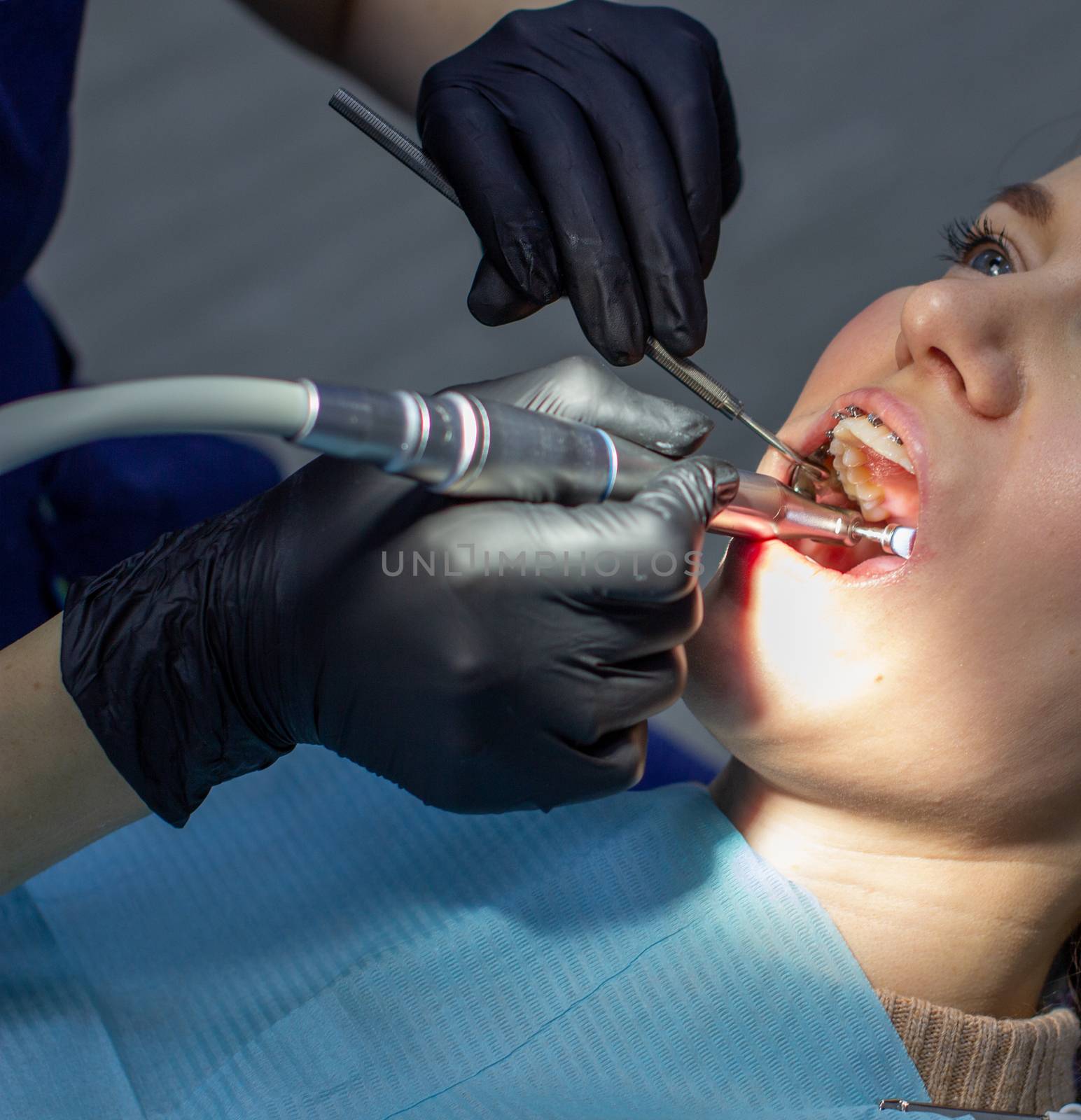 A woman with dental braces visits an orthodontist at the clinic. in the dental chair during the procedure of installing braces on the upper and lower teeth. Dentist and assistant work together, they have dental instruments in their hands. concept of dentistry